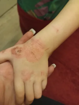 Аллергия у ребенка на руках фотографии