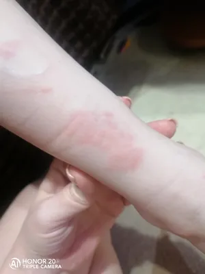 Фото аллергии на руках у ребенка в большом размере