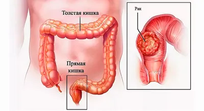 Колоректальный рак