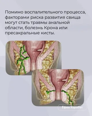 Рак Прямой Кишки — стоковые фотографии и другие картинки Раковая опухоль -  Раковая опухоль, Анатомия, Белый фон - iStock