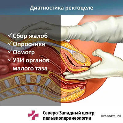 Модель колоректального поражения человека. Патологическая анатомия.  Заболевания толстой кишки. Медицинское обучение. – лучшие товары в  онлайн-магазине Джум Гик