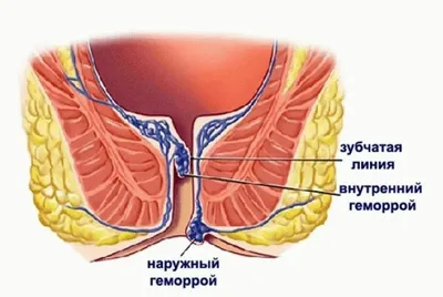 Выпадение прямой кишки при геморрое: что это и как лечится | Выпадение  геморроидальных узлов