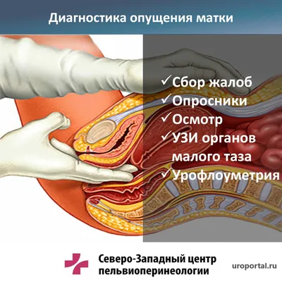 Ректоцеле: симптомы, диагностика, лечение, операция