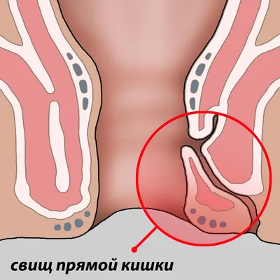 Свищ прямой кишки (параректальный свищ): причины, симптомы, виды,  осложнения, лечение, профилактика