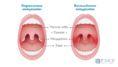 Ангина картинки фотографии