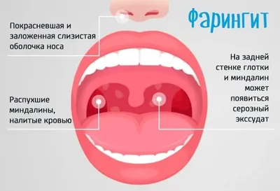 Ангина: причины, и симптомы, лечение, диагностика и профилактика ангины