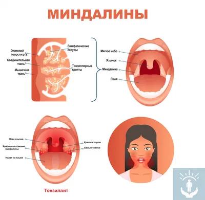 Фарингит и ангина летом. Как лечить | Доктор Лесков | Дзен