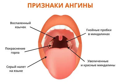 Ангина - механизм развития, классификация, симптомы, осложнения,  диагностика и лечение