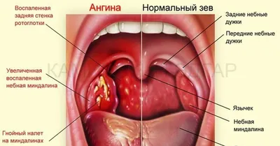 Все про ангину: как не допустить и чем лечить?