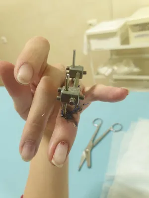 Аппарат Илизарова на руке: фото для использования в медицинских учреждениях