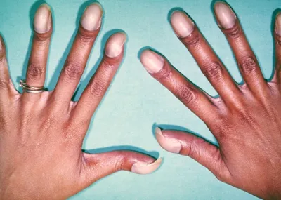 Артрит большого пальца руки: впечатляющие фотографии