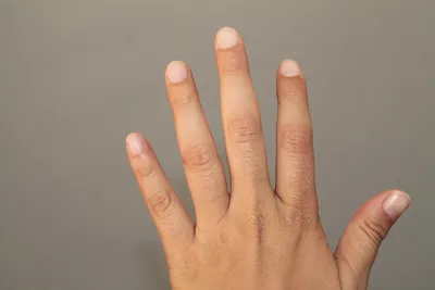 Фото артрита большого пальца руки: выберите формат для скачивания