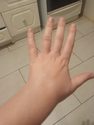 Фотография артрита большого пальца руки в PNG