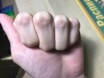 Картинка артрита большого пальца руки для скачивания