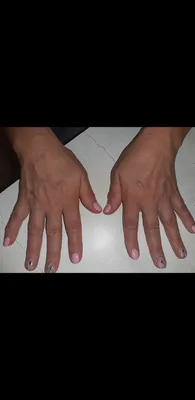 Фотография большого пальца руки с артритом в низком разрешении