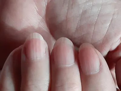 Изображение артрита большого пальца руки в профиле