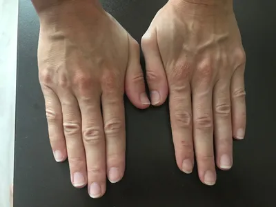 Фото артрита большого пальца руки на фоне природы
