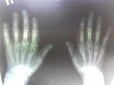 Картинка артрита большого пальца руки с медицинской тематикой
