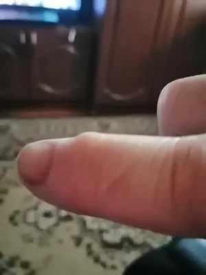 Изображение большого пальца руки с артритом на черном фоне