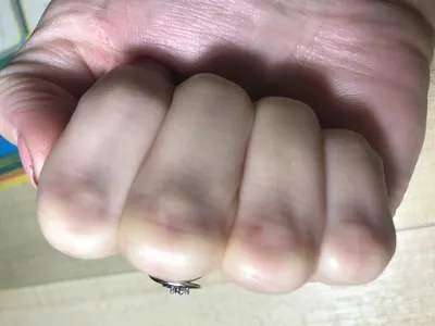 Фотография артрита большого пальца руки у пожилого человека