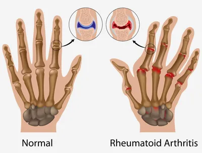 Изображение артрита кистей рук для скачивания