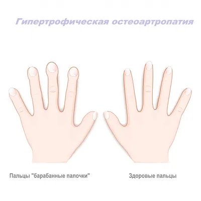 Фотография артрита кистей рук в формате JPG