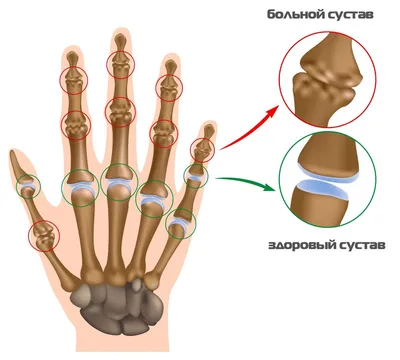 Артрит на пальцах рук: причины и факторы риска