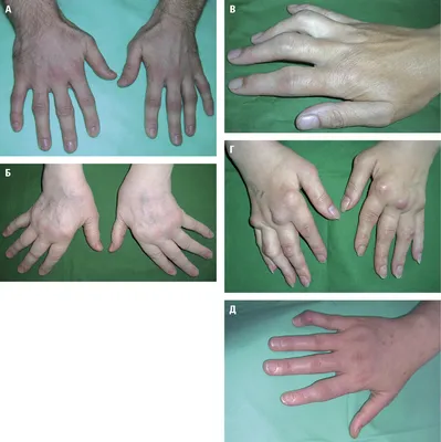 Фотографии больных пальцев рук с артритом