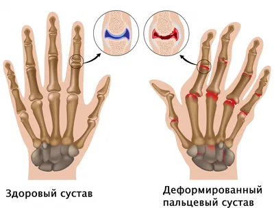 Фото рук с артритом: увеличенный размер