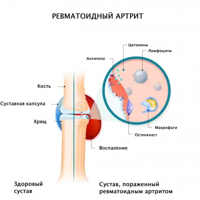 Фото артрита пальцев рук для медицинских целей