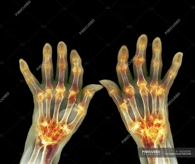 Картинка артрита рук: симптомы и профилактика