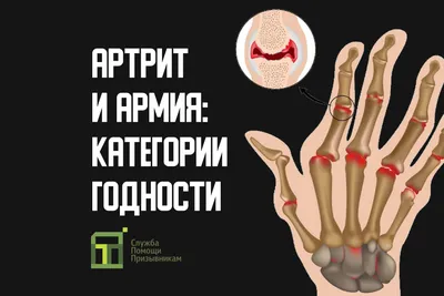 Фотография артритической руки: как сохранить здоровье