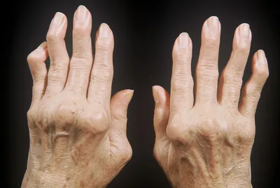 Изображение рук с артритом: последствия и реабилитация