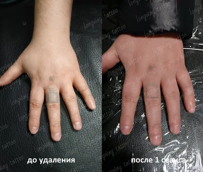 Изображение больных рук с артритом
