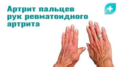 Изображение рук с артритом
