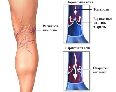 Изображение артрита суставов пальцев рук с использованием зеркального отражения