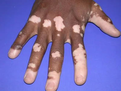 Фотография артрита суставов пальцев рук с использованием графических элементов