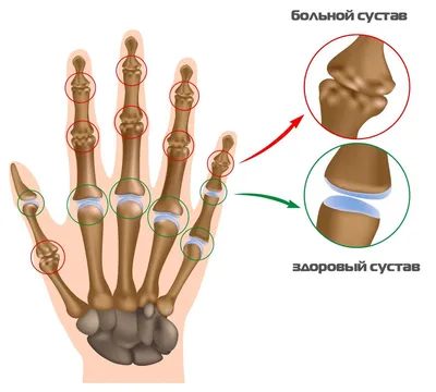 Фото артрита суставов пальцев рук на белом фоне