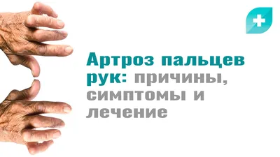 Фото артроза большого пальца руки с подписью Как выглядит артроз