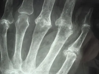 Фото Артроз кистей рук: как сохранить здоровье суставов