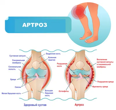Картинка Артроз кистей рук: мифы и реальность