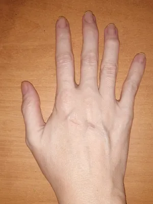 Картинка Артроз кистей рук: полезные советы от врача