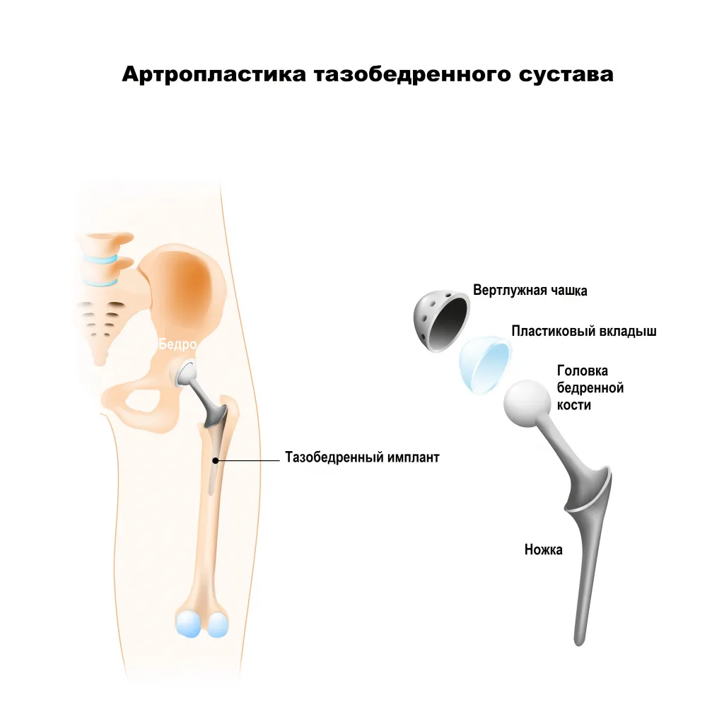 Замена сустава осложнения. Двустороннее эндопротезирование коленных суставов. Артроз коленного сустава имплант. Протезирование тазобедренного сустава.