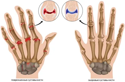 Изображения артроза пальцев рук: как распознать и предотвратить