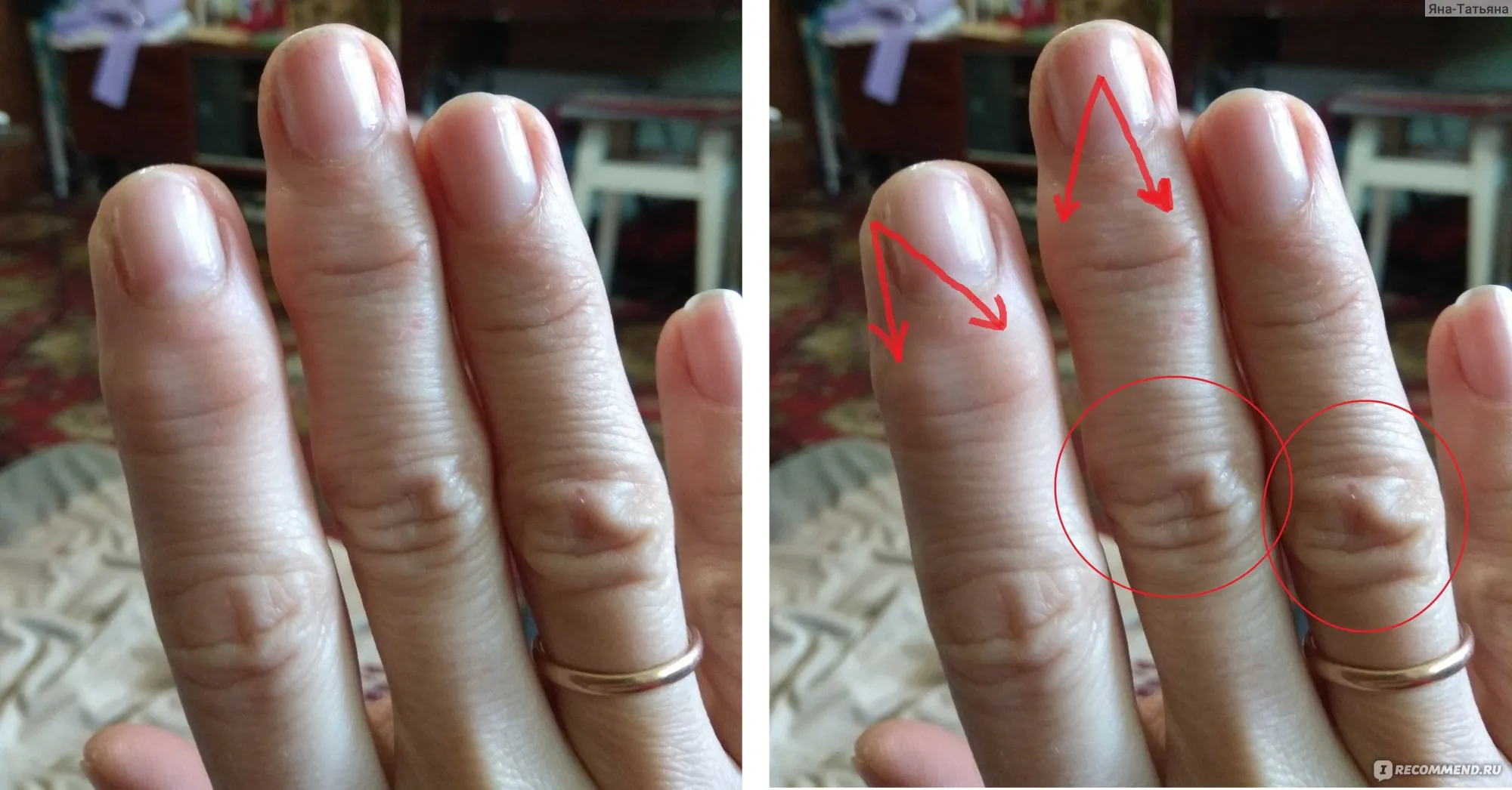 Артроз на пальцах рук лечение фото
