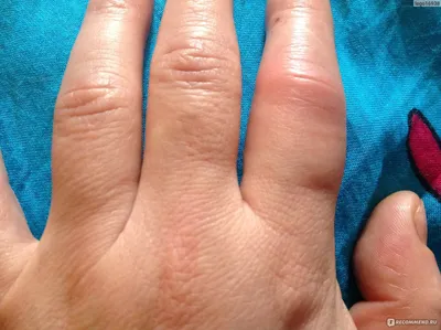 Фотография артроза руки: как предотвратить заболевание