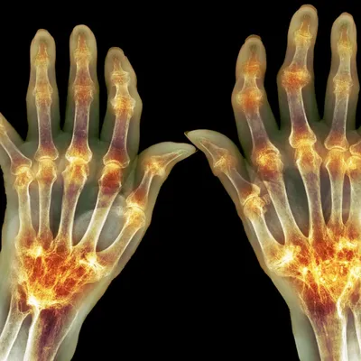 Изображение артроза руки: прогрессия заболевания