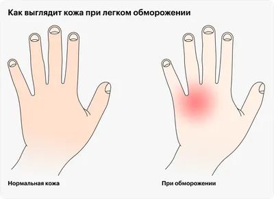Фотография руки с артрозом: мужчина страдает от заболевания