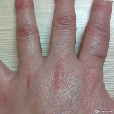 Изображение артроза руки: основные симптомы заболевания