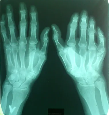 Артроз суставов пальцев рук: фото в высоком разрешении